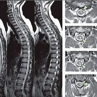 Diagnose van thoracale osteochondrose