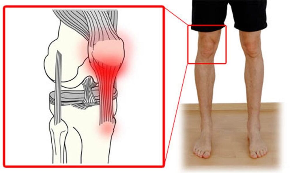 Tendinitis – ontsteking van de pezen in het kniegewricht