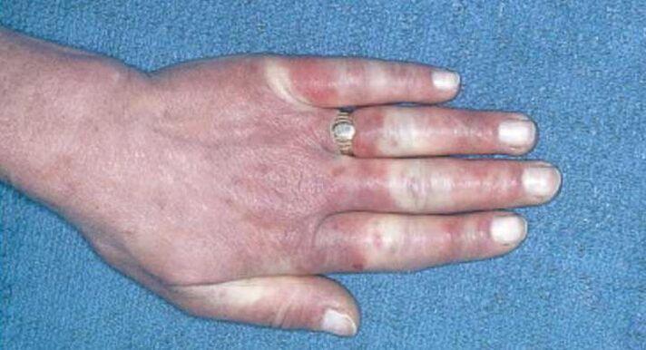 Klinisch beeld van het syndroom van Raynaud - vasospasme, hyperemie, oedeem
