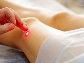 Behandeling van artrose van het kniegewricht met een laser